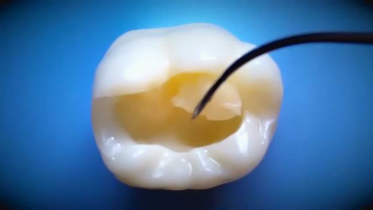 拍摄真实的树脂补牙过程,牙齿龋坏就是这样补起来的!_高清1080P在线观看平台_腾讯视频