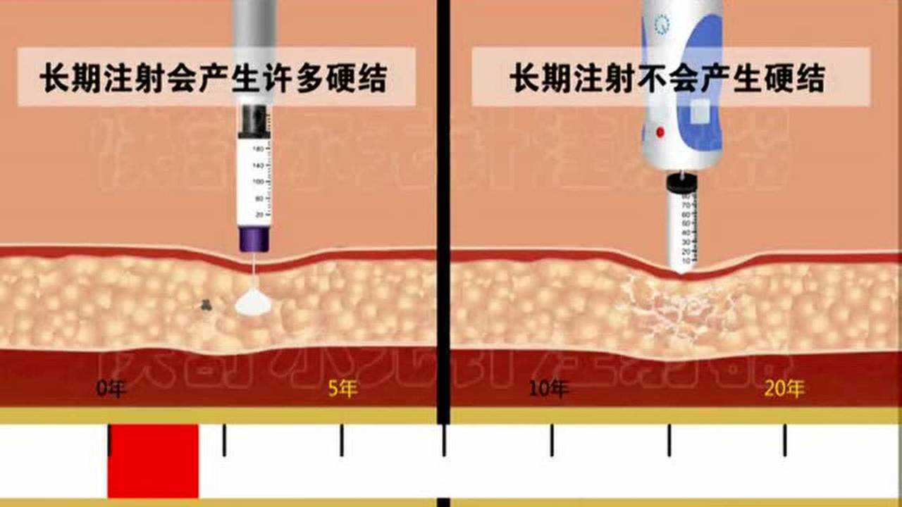 無針胰島素注射器與有針注射器的區別(三)