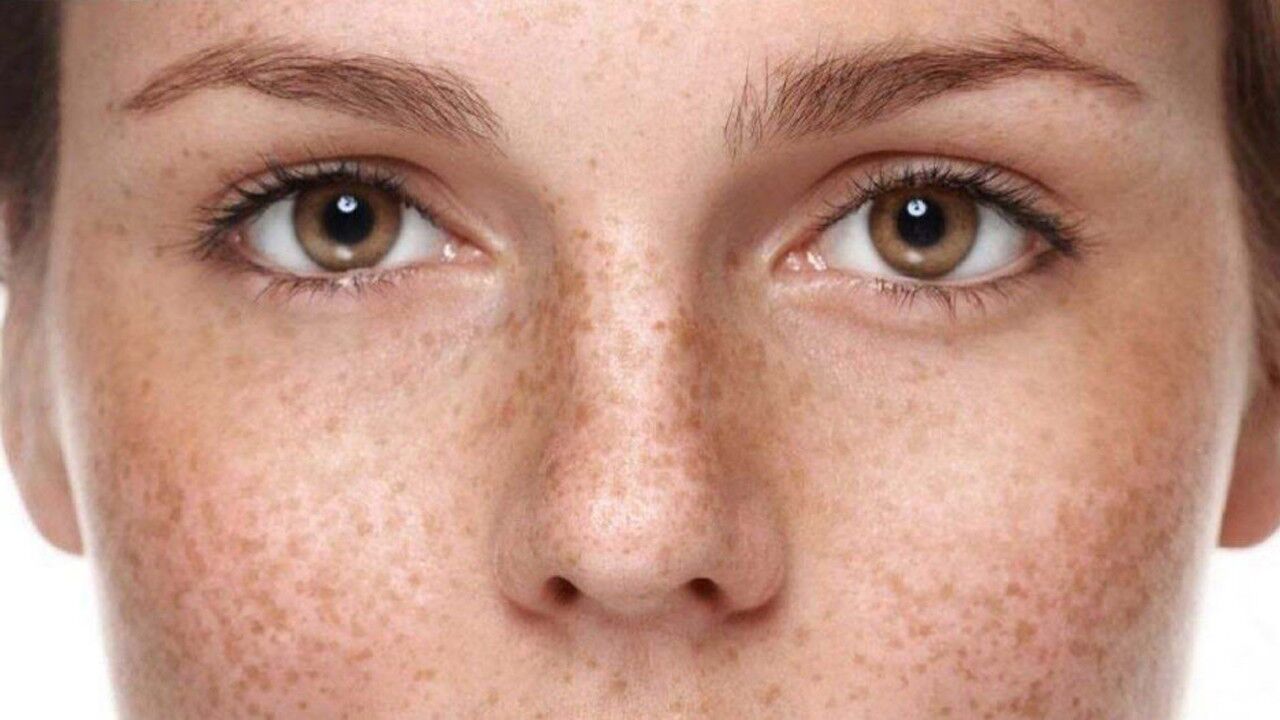 满脸黄褐斑如何祛除?这些中药偏方来帮您