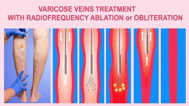 下肢静脉曲张的治疗,把握最佳治疗时期和有效方法最关键