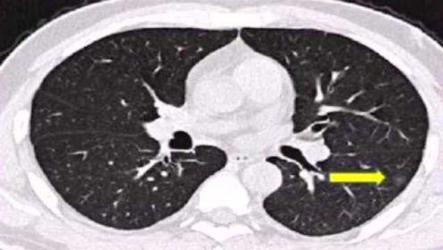 每天一个小知识!专家教你看会新冠病毒感染CT成像图,浅显易懂!