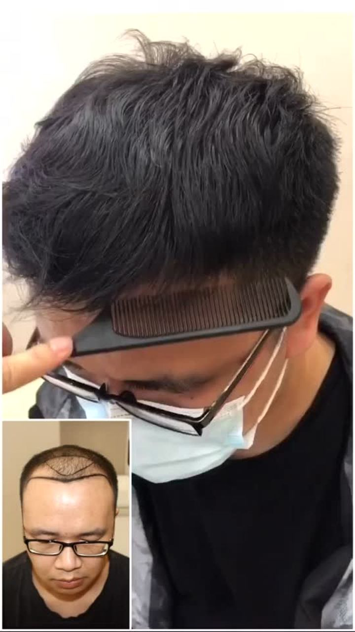 男士植发一年后效果