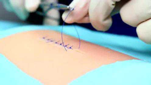 Simple interrupted suture (wound suturing) 伤口是怎样缝合的?