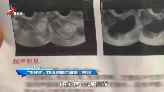 串串惹的祸?女子一蹲就腹痛 医生:已经插进子宫了