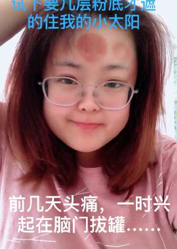 劝大家不要在脑门拔罐……不然