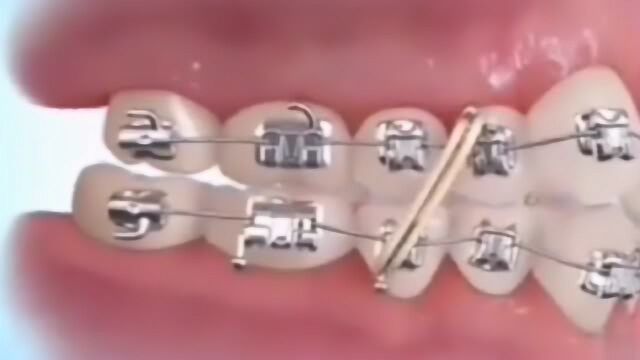 医学3D动画,牙齿矫正的全过程,感叹自己幸好又两排整整齐齐的牙齿!
