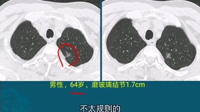 磨玻璃肺结节,恶性的CT片怎么看?