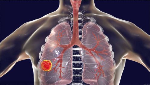 肺癌一发现就是晚期？医生忠言：若近期上半身有4个异常，别忽视