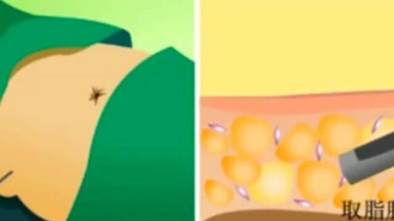 抗衰神器：svf脂肪干细胞是什么？为何最近这么火？_腾讯视频