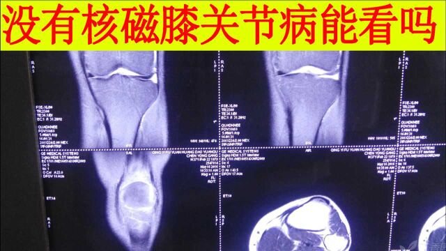 没有核磁膝关节病还能诊治吗?越来越突破人的底线!