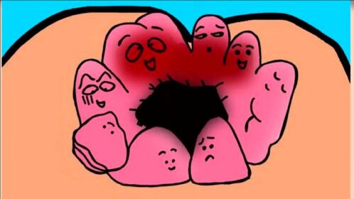 痔疮越长越多,肛门长了一圈肉球是怎么回事?