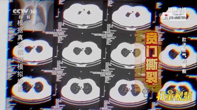 男子总腹胀、打嗝,之后竟出现吐血,一查竟是贲门撕裂