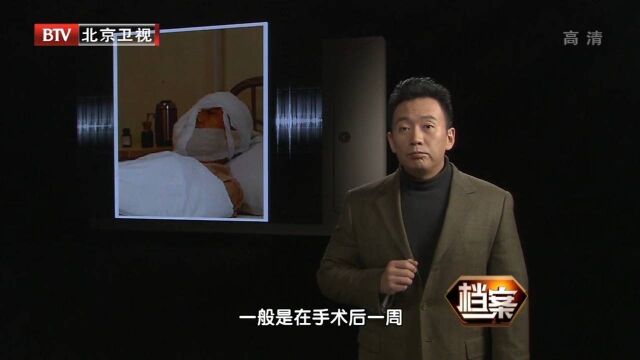 李国兴成功换脸,未出现超急性排斥反应,这一奇迹震惊世界