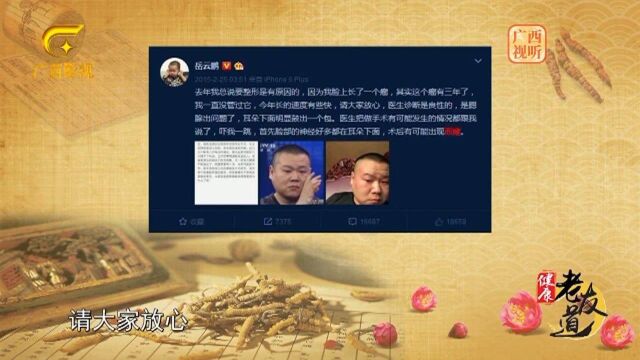 什么是面瘫?医生总结了几条常见症状