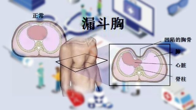 胸骨凹陷形状像“漏斗”,何时是漏斗胸的矫正最佳时期?