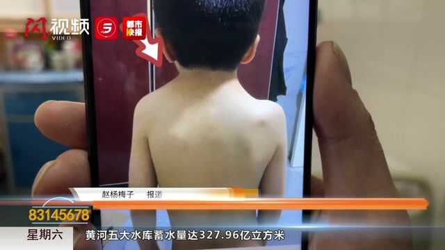 六岁男孩“高低肩”医生妙手医治