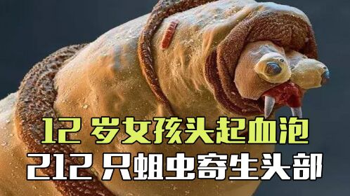 86岁老人耳朵生蛆,12岁女孩头顶寄生212只蛆虫,苍蝇为何把卵产在人