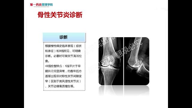 骨性关节炎的病理介绍