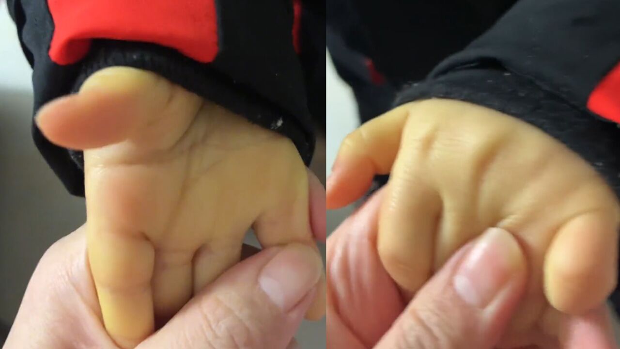 幼童手脚突然发黄,妈妈吓到上网查询后"戒"橘子:几天吃半麻袋