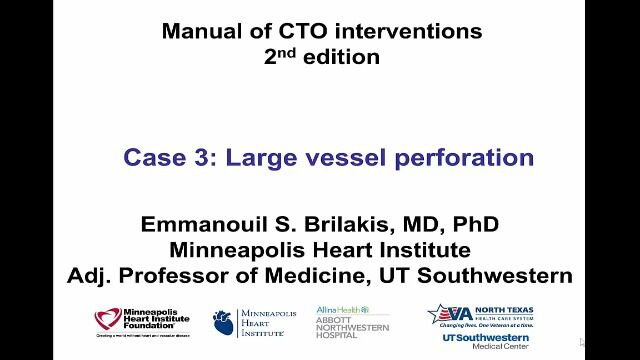 Case 3 Manual of CTO Interventions  Large vessel perforation