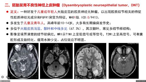 王蔚主任--中枢神经系统具有少突胶质细胞样形态肿瘤归纳及诊断-2