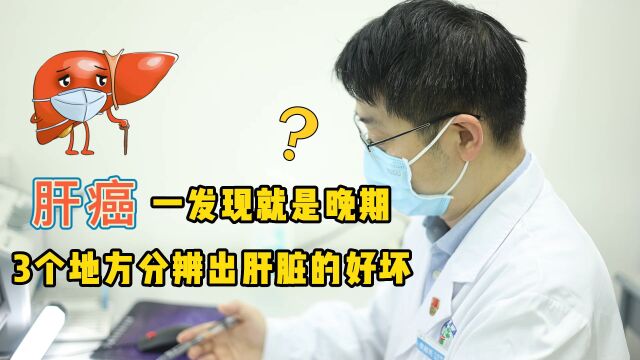 肝癌不痛不痒,发现就是晚期?提醒:3个地方分辨出肝脏的好坏