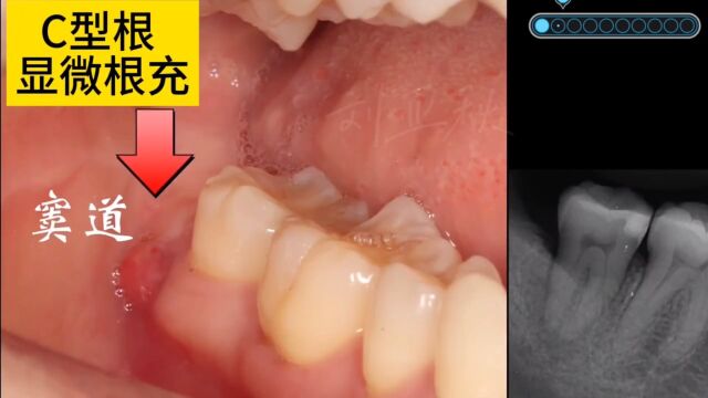 【根管治疗】c型根 显微根充