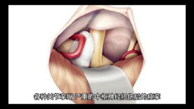 2023年7.21绵阳市高谦联合宋道锋打造全国新内热针疼痛技术精讲培训班 限时特价980元