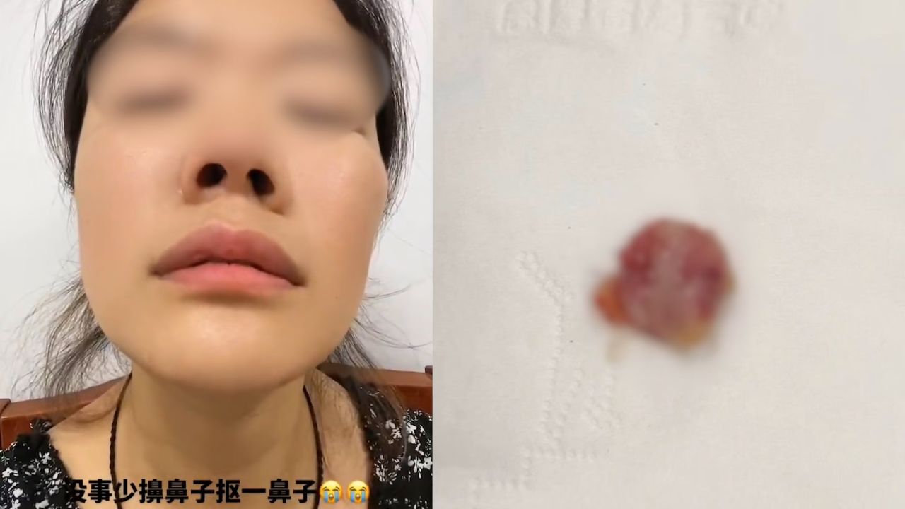 女子擤鼻涕掉出鼻息肉住院,狂冒血从嘴巴流入喉咙,医生:实属罕见