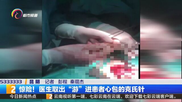 惊险!医生取出“游”进患者心包的克氏针