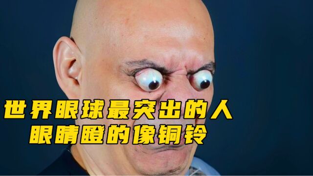 “眼睛瞪得像铜铃”,世界上眼球最突出的人,可弹出18.2毫米