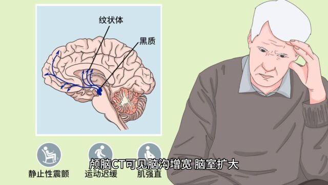 帕金森病又名震颤麻痹