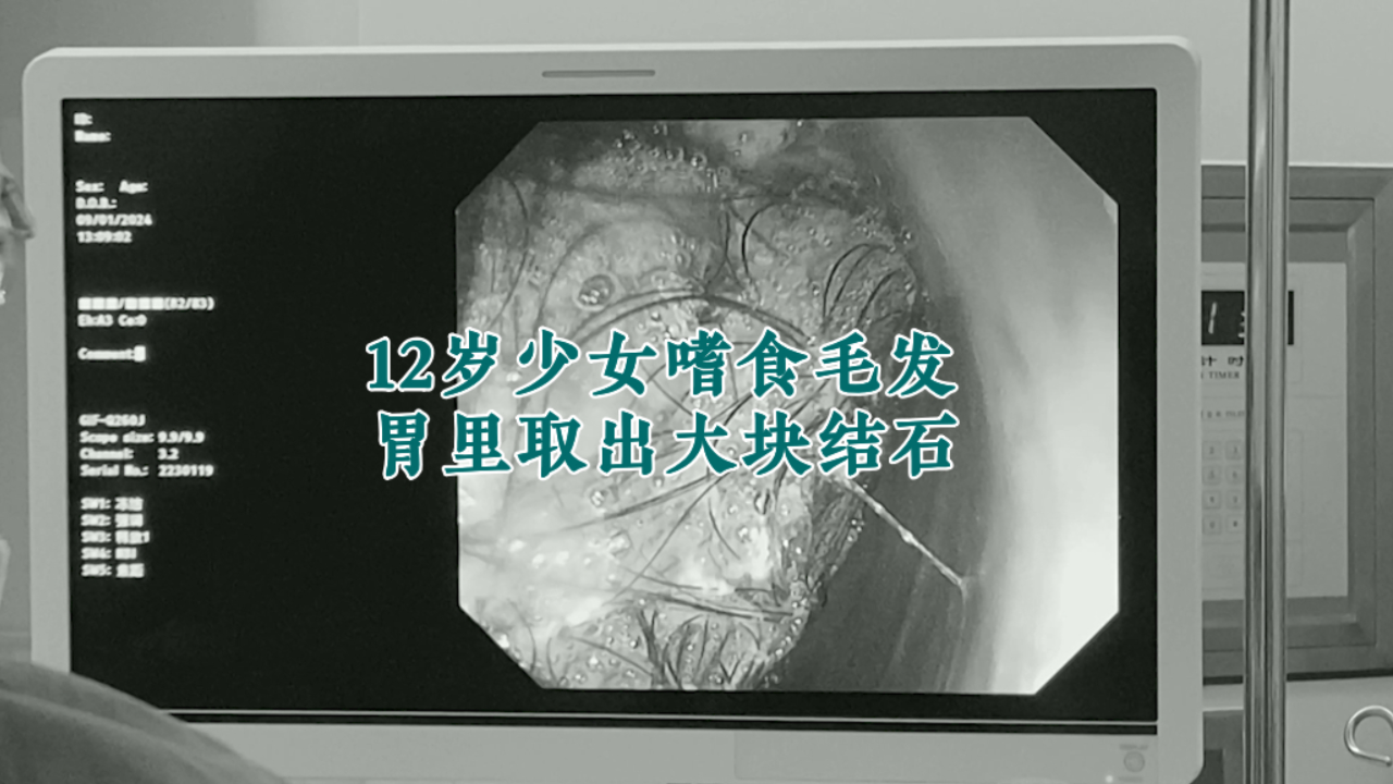 12岁少女嗜食毛发 胃里取出大块结石