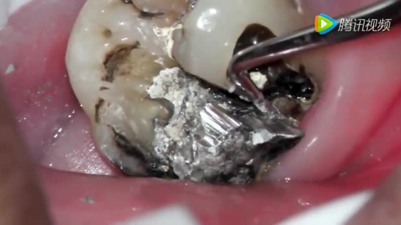 看完这个补牙过程才明白牙齿健康实在太重要_高清
