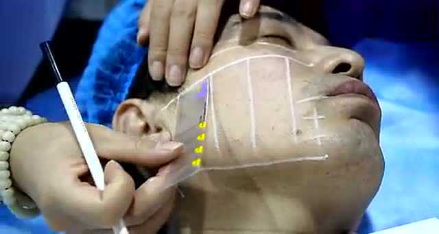 超声刀操作划线视频_腾讯视频