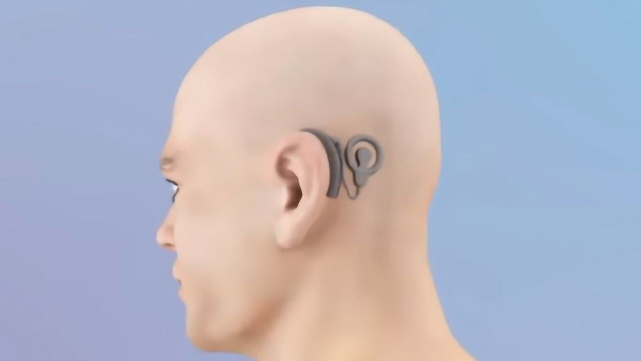 3d动画演示人工耳蜗植入全过程它的价格你根本想不到