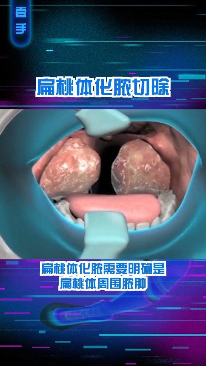 3d醫學視頻扁桃體化膿切除真的是看著都嗓子疼啊