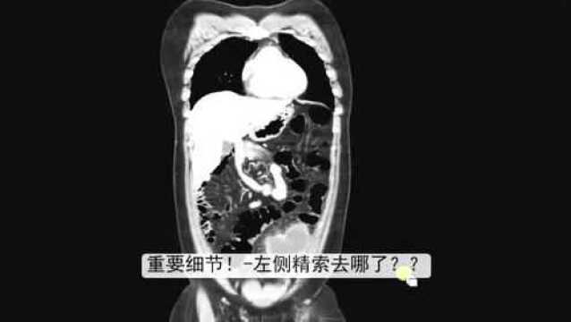 阴囊里面摸不到睾丸,不被重视,结局可怕