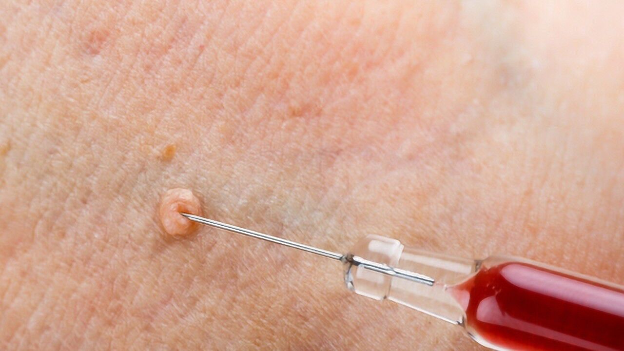 脖子上长出小肉疙瘩医生可能暗示这3种毛病别动手乱抠