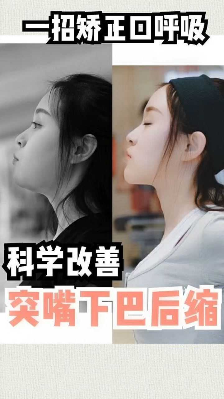 口呼吸导致下巴后缩嘴巴突出,教你一招矫正