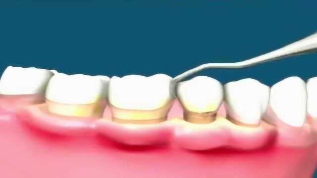 经常不刷牙的后果竟是牙龈红肿萎缩暴露压根,动画看清理过程!