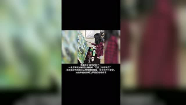 在无锡 她出生时全身密布“巧克力咖啡斑