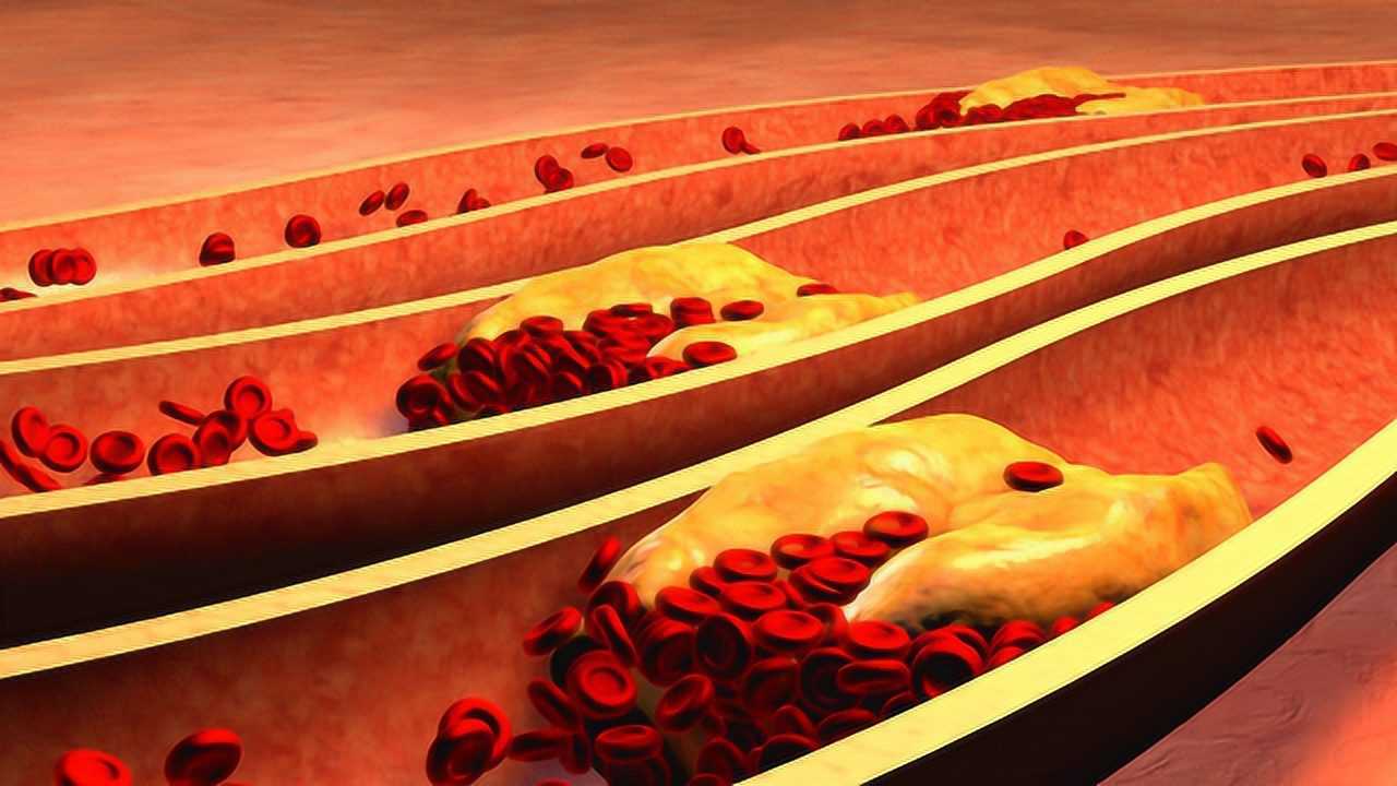 疏通血管斑块,老中医教您这样养护血管,远离心脑血管疾病