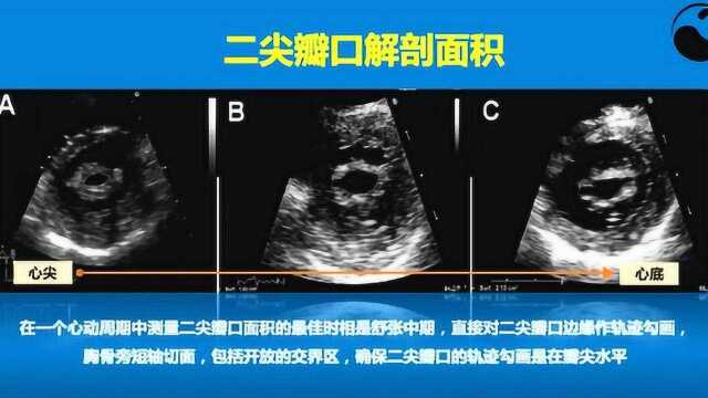 华医心诚超声心动图十大基本功7.3:二尖瓣狭窄的超声心动图定量