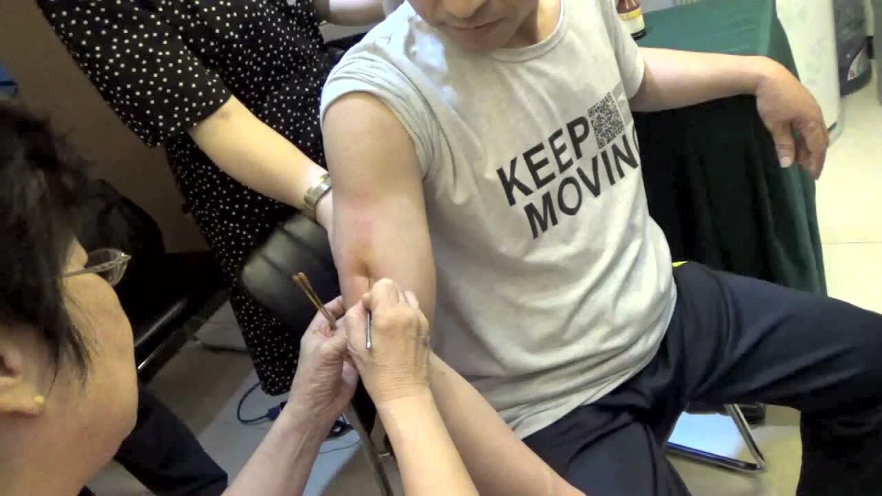 李玲 针灸治疗 胳膊受限 疼痛.针灸培训班