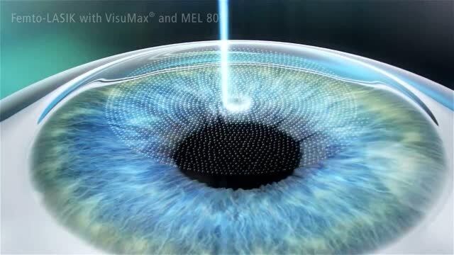 半飞秒激光近视手术3D动画演示