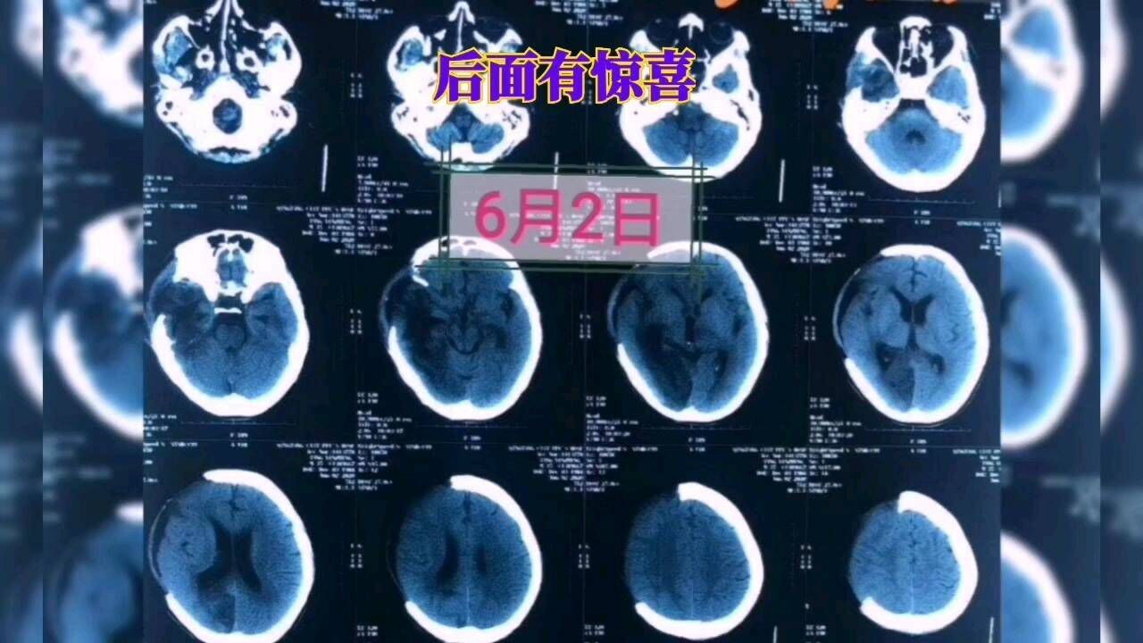 昏迷病人的促醒之路是个漫长的过程,请家属一定要耐心坚持.#生活窍门#腾讯视频