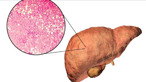 做好这1件事,脂肪肝消的快
