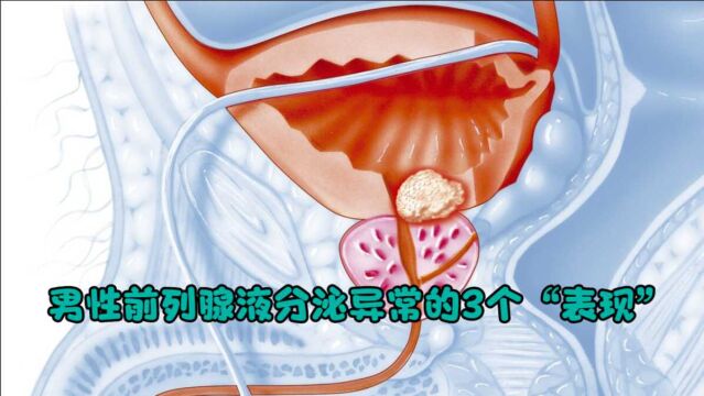 男性前列腺液分泌异常的3个“表现”,占了一个,也要及时检查