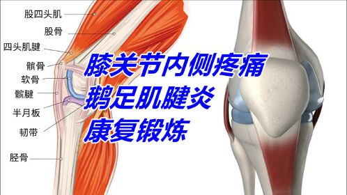 膝关节内侧疼痛,鹅足肌腱炎 ,康复锻炼